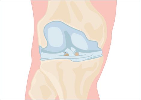 Qu'est-ce que l'arthrose du genou ?